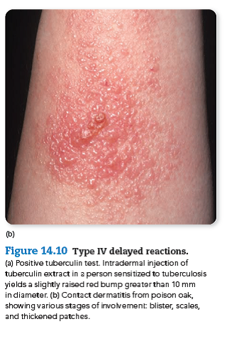 This question connects previous images to a new concept. From chapter 14, figure 14.10 b. Imagine that this patient is being seen by his or her physician for this unknown rash. What rapid phenotypic test could suggest that this condition is caused by a bacterium? Could a rapid immunoassay or fluorescent procedure be used to identify a specific viral cause? Explain your answer. Reference: chapter 14, figure 14.10 b