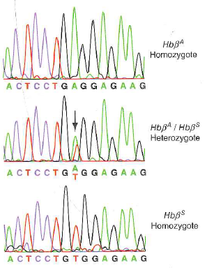 You sequence a PCR product amplified from a person's genome, and you see a double peak such as that seen in Fig. 10.11b. Most of the time, this result indicates that the person is a heterozygote for a SNP at that position. But it is also possible that the result is due to a mistake in DNA replication during the PCR amplification, with DNA polymerase misincorporating the wrong nucleotide. a. If you saw a double peak in the sequence trace, did the mistake happen in the first few rounds of PCR amplification or in the last few rounds b. Whether or not you see a double peak, is it more likely that a mistake would happen in the first few rounds of PCR amplification or in the last few rounds c. Given that mistakes can happen during PCR amplification, what could you do to ever be sure of a person's genotype Why would this degree of certainty be difficult to achieve if you were doing preimplantation genotyping of embryos d. PCR relies on heat-stable DNA polymerases from thermophilic bacteria that grow in hot springs. The DNA polymerase originally used for PCR, from the bacterium Thermus aquaticus, lacks the 3 -to-5 exonuclease found in other DNA polymerases such as that from E. coli (review Fig. 7.9). Why do scientists now most often use DNA polymerase from a different thermophilic bacterium ( Pyrococcus furiosa ) that does contain this exonuclease function Figure 10.11 Detection of the sickle-cell mutation by sequencing of PCR products. (b) Sequencing of PCR products made using genomic DNA templates from individuals with normal and mutant alleles of this SNP locus. Note that the sequence of the PCR product from a heterozygous carrier shows both the normal ( Hb A ) and mutant ( Hb s ) nucleotides at the position of the substitution. (b) Genotyping for sickle-cell anemia Figure 7.9 DNA polymerase's proofreading function. If DNA polymerase mistakenly adds an incorrect nucleotide at the 3 end of the strand it is synthesizing, the enzyme's 3 -to-5 exonuclease activity removes this nucleotide, giving the enzyme a second chance to add the correct nucleotide.