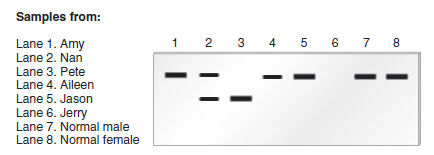 Chapter 20 describes a blotting method known as Western blotting that can be used to detect a polypeptide that is translated from a particular mRNA. In this method, a particular polypeptide or protein is detected by an antibody that specifically recognizes a segment of its amino acid sequence. After the antibody binds to the polypeptide within a gel, a secondary antibody (which is labeled) is used to visualize the polypeptide as a dark band. For example, an antibody that recognizes -galactosidase A could be used to specifically detect the amount of -galactosidase A protein on a gel. The enzyme -galactosidase A is defective in individuals with Fabry disease, which shows an X-linked recessive pattern of inheritance. Amy, Nan, and Pete are siblings, and Pete has Fabry disease. Aileen, Jason, and Jerry are brothers and sister, and Jerry has Fabry disease. Amy, Nan, and Pete are not related to Aileen, Jason, and Jerry. Amy, Nan, and Aileen are concerned that they could be carriers of a defective -galactosidase A gene. A sample of cells was obtained from each of these six individuals and subjected to Western blotting, using an antibody against -galactosidase A. Samples were also obtained from two unrelated normal individuals (lanes 7 and 8). The results are shown here. a. Note: Due to X inactivation in females, the amount of expression of genes on the single X chromosome in males is equal to the amount of expression from genes on both X chromosomes in females a. Explain the type of mutation (i.e., missense, nonsense, promoter, etc.) that causes Fabry disease in Pete and Jerry b. What would you tell Amy, Nan, and Aileen regarding the likelihood that they are carriers of the mutant allele and the probability of having affected offspring