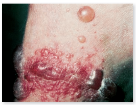 From chapter 16, process figure 16.16 b. Imagine that this patient is being seen by his or her physician for this unknown rash. What rapid phenotypic test could suggest that this condition is caused by a bacterium Could a rapid immunoassay or fluorescence procedure be used to identify a specific viral cause Explain your answer. Figure 16.16 Contact dermatitis. (b) Contact dermatitis from poison oak, showing various stages of involvement: blister, scales, and thickened patches.