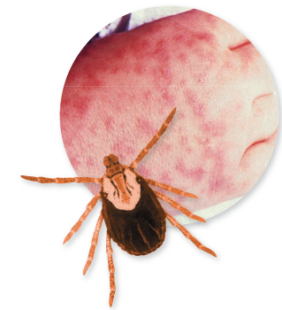 From chapters 20 and 23, figures 20.16 and 23.13 a. Compare these two rashes. What kind of information wouldhelp you determine the diagnosis in both cases b. Now compare both of these to the rashes summarized in Disease Table 18.7 (p. 532-533). Which of the diseases in Disease Table 18.7 most resembles the rashes in the preceding question, and how would you distinguish among it, the rash from figure 20.16, and the one from figure 23.13 a Figure 20.16: The rash in RMSF. This case occurred in a child several days after the onset of fever. Also pictured is an example of the hard ticks that transmit the infection. Figure 23.13 a : Symptom of secondary syphilis. The skin rash in secondary syphilis can form on the trunk, arms, and even palms and soles (these latter locations are particularly diagnostic). The rash does not hurt or itch and can persist for months. Disease Table 18.7: Maculopapular Rash Diseases