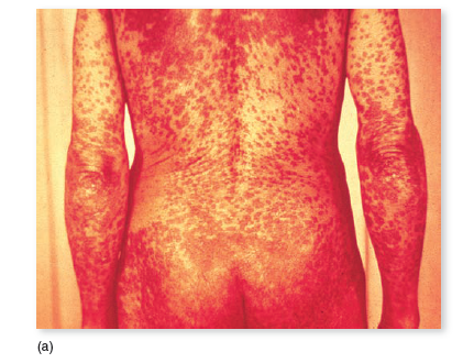 From chapters 20 and 23, figures 20.16 and 23.13 a. Compare these two rashes. What kind of information wouldhelp you determine the diagnosis in both cases b. Now compare both of these to the rashes summarized in Disease Table 18.7 (p. 532-533). Which of the diseases in Disease Table 18.7 most resembles the rashes in the preceding question, and how would you distinguish among it, the rash from figure 20.16, and the one from figure 23.13 a Figure 20.16: The rash in RMSF. This case occurred in a child several days after the onset of fever. Also pictured is an example of the hard ticks that transmit the infection. Figure 23.13 a : Symptom of secondary syphilis. The skin rash in secondary syphilis can form on the trunk, arms, and even palms and soles (these latter locations are particularly diagnostic). The rash does not hurt or itch and can persist for months. Disease Table 18.7: Maculopapular Rash Diseases