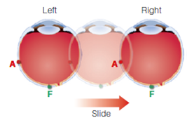 How could you determine the contribution of binocular vision to depth perception? One way would be to close one eye and notice how this affects your perception. Try this, and describe any changes you notice. Then devise a way to quantitatively measure the accuracy of depth perception that is possible with two-eyed and one-eyed vision. Figure 1 Corresponding points on the two retinas. To determine corresponding points, imagine that the left eye is slid on top of the right eye. F indicates the fovea, where the image of an object occurs when an observer looks directly at the object, and A is a point in the peripheral retina. Images on the fovea always fall on corresponding points. Notice that the A's, which also fall on corresponding points, are the same distance from the fovea in the left and right eyes. Figure 2 (a) An observer looking at Julie's face, with a tree off to the side. (b) The observer's eyes, showing where the images of Julie and the tree fall on each eye. Julie's images fall on the fovea, so they are on corresponding points. The arrows indicate that the tree's images are located the same distances from the fovea in the two eyes, so they are also on corresponding points. The dashed blue line is the horopter. The images of objects that are on the horopter fall on corresponding points.