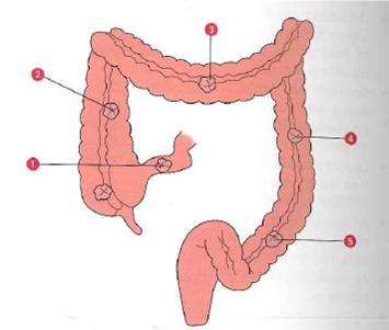 A student nurse is assigned to care for a client with a sigmoidostomy. The student will assess which ostomy site?  <div style=padding-top: 35px> 