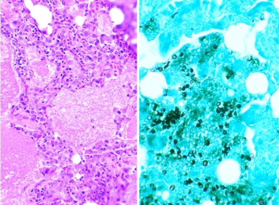 <strong>This lung lesion was identified at the autopsy of a 40-year-old man infected with human immunodeficiency virus (HIV). It is illustrated here in a hematoxylin and eosin stained section and a silver methenamine impregnated section. This lesion is caused by a  </strong> A) bacterium B) fungus C) virus D) protozoon E) nematode <div style=padding-top: 35px> 