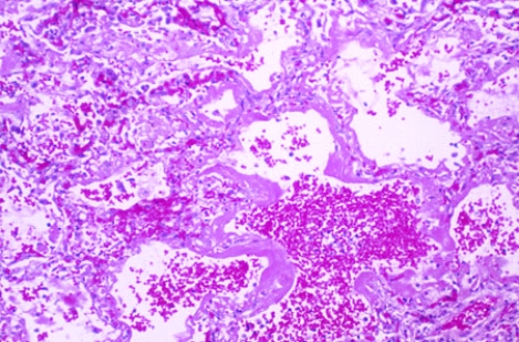 <strong>This lung lesion was found at the autopsy of a 40-year-old man who suffered extensive burns to 50% of his body surface. These changes are most consistent with the diagnosis of  </strong> A) atelectasis B) emphysema C) bronchiolitis obliterans-organizing pneumonia (BOOP) D) adult respiratory distress syndrome E) lobar pneumonia <div style=padding-top: 35px> 