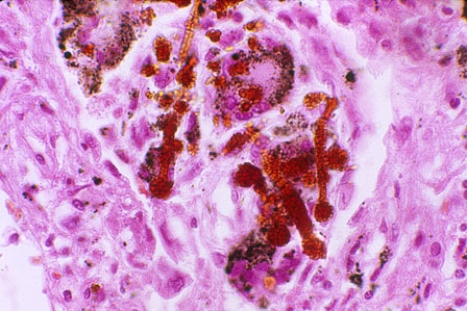 <strong>This lung lesion is diagnostic of  </strong> A) anthracosis B) asbestosis C) silicosis D) bagassosis E) berylliosis <div style=padding-top: 35px> 