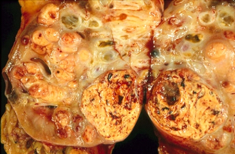 <strong>This nephrectomy specimen shows a lesion in the kidney of a 63-year-old man. The lesion is most likely related to </strong> A) a deletion of von Hippel-Lindau (VHL) tumor suppressor gene B) a mutation of myc oncogene C) an amplification of ras oncogene D) a loss of bcl-2 proapoptotic gene E) an aflatoxin related carcinogen