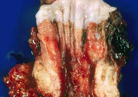 <strong>This esophageal carcinoma developed in a 65-year-old man who had reflux esophagitis for 15 years. Most likely this tumor was histologically classified as </strong> A) adenocarcinoma B) squamous cell carcinoma C) transitional cell carcinoma D) basal cell carcinoma E) oat cell carcinoma