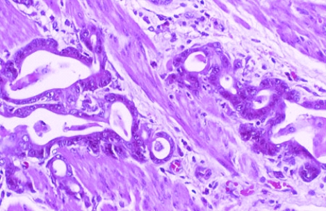 <strong>This slide shows the muscle layer of a stomach that was removed from a 60-year-old man who complained of dyspepsia and bleeding. The tissue section was taken from the muscle underneath a large prepyloric ulcer. Which of the following is the most likely diagnosis? </strong> A) Peptic ulcer disease B) Helicobacter pylori-related gastritis C) Autoimmune gastritis D) Hyperplastic gastropathy E) Adenocarcinoma