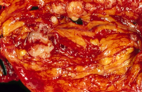 <strong>This figure shows a portion of the mesentery and omentum removed during a work-up of a 60-year-old woman with ascites and large multicystic ovarian masses. The lesions seen here are most consistent with the diagnosis of </strong> A) primary peritoneal benign tumor B) primary peritoneal malignant tumor C) metastatic carcinoma D) metastatic sarcoma E) lymphoma