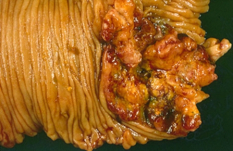 <strong>This small intestinal lesion was removed from a 56-year-old woman and is most likely a </strong> A) tubular adenoma B) hamartoma C) carcinoma D) sarcoma E) pseudopolyp