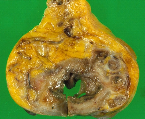 <strong>This slide illustrates the lesions seen in the partial colectomy specimen obtained from a 78-year-old man who has chronic constipation, left lower quadrant pain, and fever. On cross section, this sigmoid colon shows changes most consistent with the diagnosis of </strong> A) Crohn disease B) toxic megacolon C) carcinoma of the colon D) carcinoid E) diverticulitis