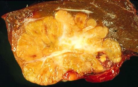 <strong>This liver tumor nodule, measuring 6 cm in diameter, was seen on a computerized tomography (CT) scan of a 40-year-old man. Initially, the nodule was considered to be benign, but when it became painful, the patient decided to have it removed. Histologically, it was composed of well-differentiated hepatocytes, whereas the central scar and the fibrous septa contained proliferating bile ducts. This nodule is most likely </strong> A) a hepatocellular adenoma B) a hamartoma C) an adenomyoma D) a focal nodular hyperplasia E) a hepatocellular carcinoma