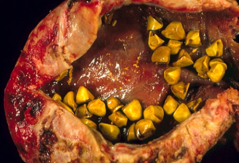 <strong>These gallstones surgically removed along with the gallbladder of a 50-year-old obese woman are composed predominantly of </strong> A) calcium carbonate B) cholesterol C) bilirubin D) biliverdin E) calcium hydroxyapatite