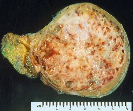 This testis was removed from a 30-year-old man. It most likely represents  