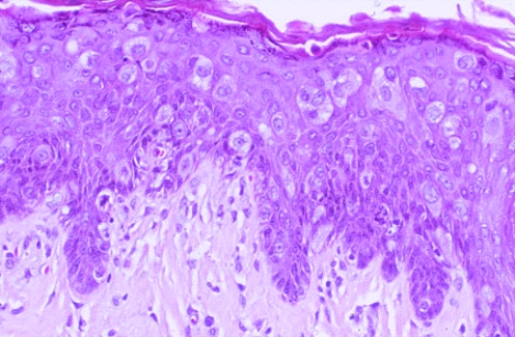 <strong>This biopsy specimen was taken from an excoriated and oozing nipple of a 50-year-old woman. These histologic findings are most consistent with the diagnosis of </strong> A) eczema B) psoriasis C) Paget disease of the breast D) medullary carcinoma of the breast E) fibrocystic change of the breast