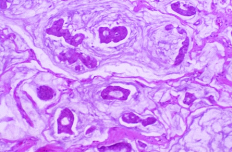 <strong>This breast tumor was removed from a 60-year-old woman. On gross examination, the tumor was found to be </strong> A) rubbery and yellow B) white and gritty C) calcified D) necrotic and caseous E) soft and gelatinous