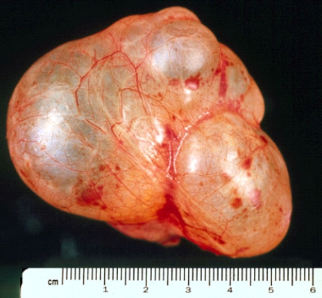 <strong>This pelvic tumor most likely originated from the </strong> A) prostate B) rectum C) urinary bladder D) ovary E) uterus