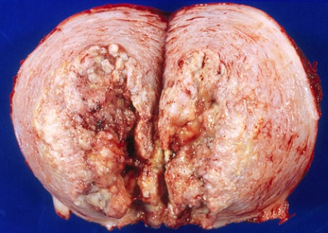 <strong>This uterus was removed from a 58-year-old woman who complained of metrorrhagia. Most likely this lesion is pathogenetically related to </strong> A) herpesvirus infection B) human papillomavirus infection C) hyperestrinism D) multiparity E) endometriosis
