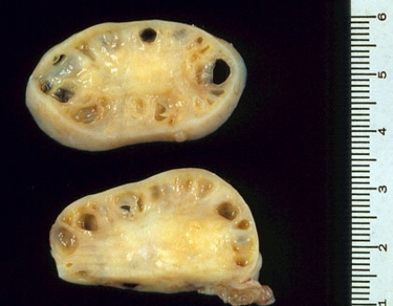 <strong>These ovaries were removed from an infertile, obese, slightly hirsute 30-year-old woman with persistent menstrual irregularities. The cystic spaces seen in the ovaries represent </strong> A) foci of endometriosis B) foci of endosalpingiosis C) corpora lutea D) corpora albicantia E) dilated follicles filled with fluid
