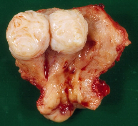 <strong>The solitary nodular lesion in this uterus removed from a 55-year-old woman is most likely composed of </strong> A) benign endometrial glandular cells B) malignant endometrial glandular cells C) benign smooth muscle cells D) malignant smooth muscle cells E) foci of adenomyosis