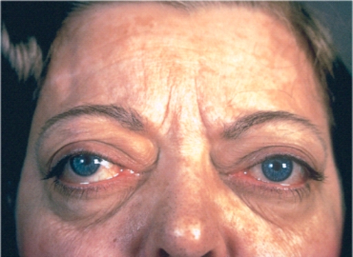 <strong>Thyroid ophthalmopathy is typically found in patients who have which of the following disorders?  </strong> A) Graves disease B) Multinodular goiter C) Toxic (hyperfunctioning) adenoma of the thyroid D) Hashimoto thyroiditis E) Riedel thyroiditis <div style=padding-top: 35px> 