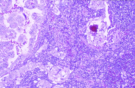 <strong>This lymph node was removed from the lateral side of the neck of a 38-year-old woman who had a thyroidectomy. She had an enlarged, painless thyroid but had no signs of altered thyroid function. The lymph node shows signs of  </strong> A) autoimmune disease B) bacterial infection C) hyperplasia D) neoplasia E) metaplasia <div style=padding-top: 35px> 