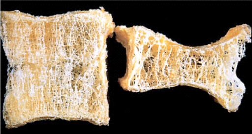 <strong>Compression fractures of vertebral bodies seen in elderly women are causally related to reduced recruitment of osteoclasts. This process is associated with an increased concentration of which chemical mediators in the bone?  </strong> A) Prostaglandins B) Leukotrienes C) Cytokines such as interleukin (IL)-1 and IL-6 D) Oncogenes such as c-MYC and K-RAS E) Fibroblast growth factors <div style=padding-top: 35px> 