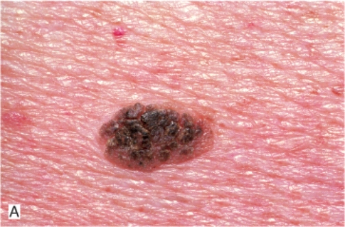 <strong>A well-demarcated, coin-like, dark brown lesion appeared on the shoulder of a 59-year-old man. The lesion appears velvety, greasy, and has a stuck on appearance so that it can easily be removed. Which of the following is the most likely diagnosis?  </strong> A) Lentigo B) Ephelis C) Vitiligo D) Seborrheic keratosis E) Actinic keratosis <div style=padding-top: 35px> 