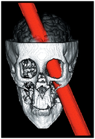 <strong>In 1848 Phineas Gage had a metal rod accidentally shot through part of his face and brain. As a result, he suffered a drastic personality transformation, with his injury and recovery documented by his physician. This is an example of a(n)_____________. </strong> A) survey B) case study C) experiment D) correlation