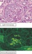 <strong>The figure shows routine histologic and immunofluorescence images of a kidney biopsy specimen taken from a 53-year-old man with acute-onset renal failure and hemoptysis (coughing up blood). The histologic section is notable for glomerular inflammation in a crescentic distribution. Staining, using fluorescently tagged anti-IgG antibody, shows linear deposits of IgG along the glomerular basement membrane. Urinalysis is positive for moderate proteinuria and red cell casts. A chest radiograph shows pulmonary infiltrates. Which of the following is the most likely diagnosis? </strong> A) Systemic lupus erythematosus B) Graves' disease C) Chronic allograft rejection D) Goodpasture's syndrome E) Poststreptococcal glomerulonephritis