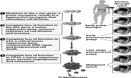 As indicated in the diagram below, in many human colon tumors, the beginning of true malignancy is the result of