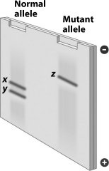<strong>The genes for the normal mutant alleles of a gene are cut with the same restriction enzyme. The resulting DNA fragments were separated by gel electrophoresis, producing the gel shown in the figure below. Why are the patterns produced by these two alleles different?  </strong> A)The normal hemoglobin gene is cut by two restriction enzymes, but the sickle cell anemia allele is cut by only one restriction enzyme. B)The gene for the normal allele is much larger than the gene for sickle cell anemia. C)The gene for the normal allele has a sequence recognized by DdeI, but the gene for sickle cell anemia does not. D)The sickle cell allele has the ability to produce ligase to repair the damage done by restriction enzymes, but the normal allele does not. <div style=padding-top: 35px> 