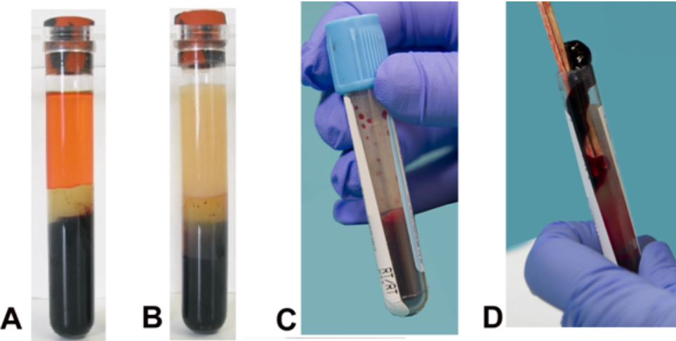 <strong> Which image represents a specimen that will be rejected by the laboratory? (check all that apply)</strong> A) Image A B) Image B C) Image C D) Image D E) All of the above
