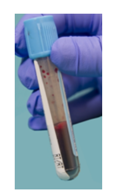 <strong> The specimen in this image needs to be recollected because</strong> A) it has an incorrect additive to blood ratio. B) RBCs have been destroyed, releasing calcium and potassium. C) coagulation proteins have been activated. D) the patient may not have been fasting.