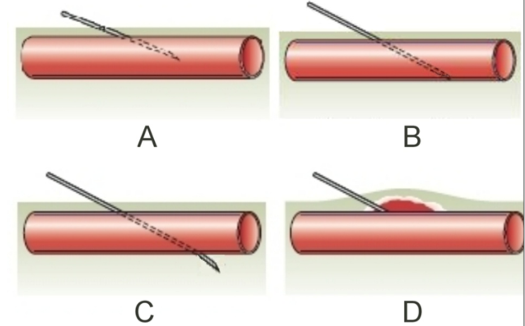 <strong> -Which of the images provided shows proper placement of the needle during venipuncture?</strong> A) Image A B) Image B C) Image C D) Image D