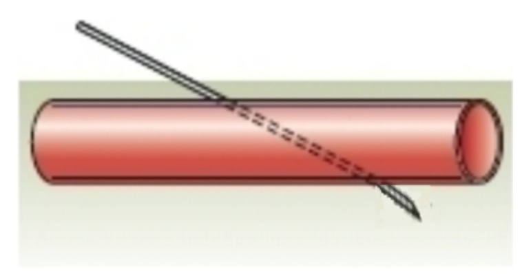 <strong> What venipuncture situation is represented by this image?</strong> A) needle against vein wall B) needle inserted too deep C) needle inserted too shallow D) proper needle insertion