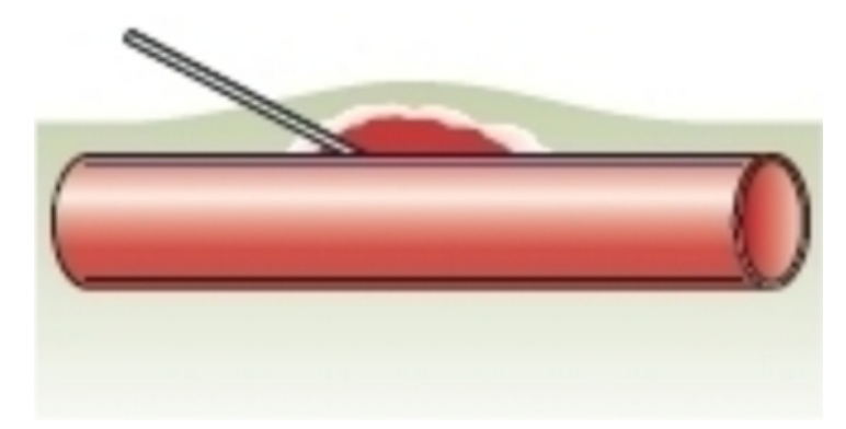<strong> What venipuncture situation is represented by this image?</strong> A) needle against vein wall B) needle inserted too deep C) needle inserted too shallow D) proper needle insertion