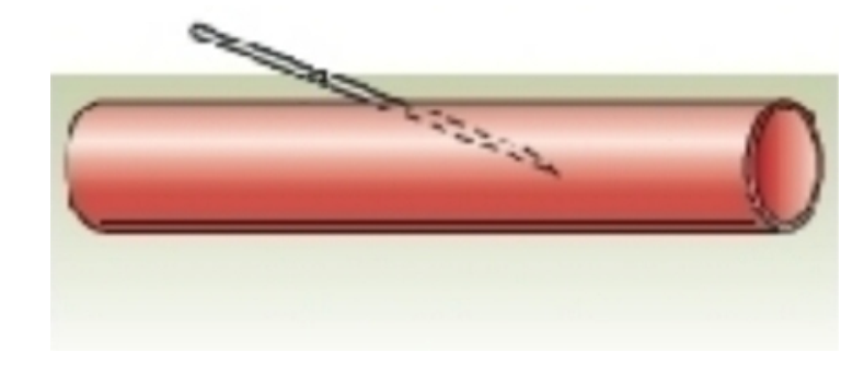 <strong> What venipuncture situation is represented by this image?</strong> A) needle against vein wall B) needle inserted too deep C) needle inserted too shallow D) proper needle insertion