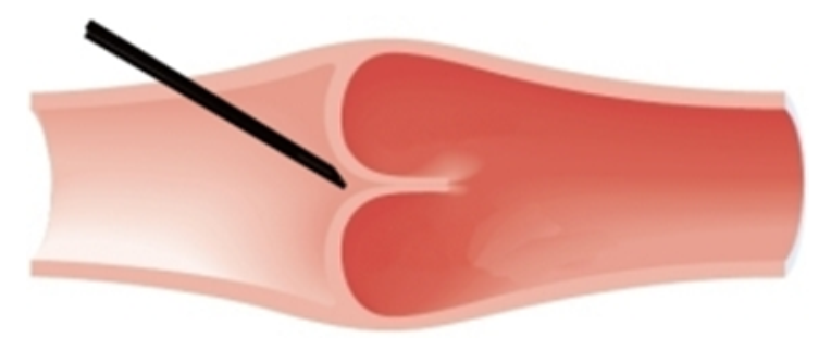 <strong> What venipuncture situation is represented by this image?</strong> A) needle inserted against the vein wall B) needle inserted too close to a valve C) needle inserted too shallow D) proper needle insertion