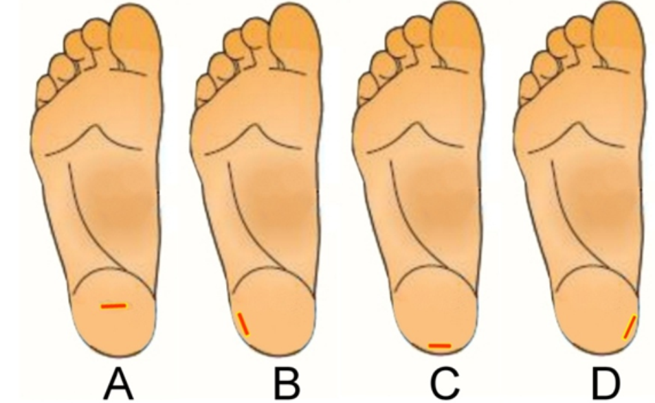 <strong> Which of the capillary punctures, in this image, is(are) performed correctly? (choose all that apply)</strong> A) Images A, B B) Images B, C C) Images B, D D) Images C, D