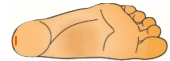 <strong> If a heelstick is performed with the cut applied as pictured in this image, what may result?</strong> A) Blood will clot before it is able to be collected. B) Blood will not form drops, but rather run along the back of the heel. C) The heel bone may become infected because there is less tissue in this area. D) No adverse situations will occur because this is the appropriate area for heelstick.