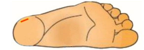 <strong> If a heelstick is performed with the cut applied as pictured in this image, what may result?</strong> A) Blood will clot before it is able to be collected. B) Blood will not form drops, but rather run along the back of the heel. C) The heel bone may become infected because there is less tissue in this area. D) No adverse situations will occur because this is the appropriate area for heelstick.