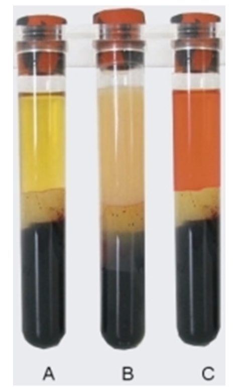 <strong> -Which specimen in this image indicates that the patient was not fasting?</strong> A) Image A B) Image B C) Image C