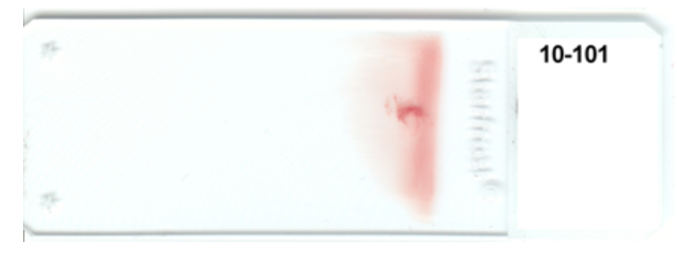 <strong> -The appearance of this blood smear is caused by using(check all that apply) i. too small of a drop of blood ii. too slow of a spreading speed iii. too steep of an angle of the spreader slide iv. a start and stop motion</strong> A) i and ii B) ii and iv C) i and iii D) ii and iii