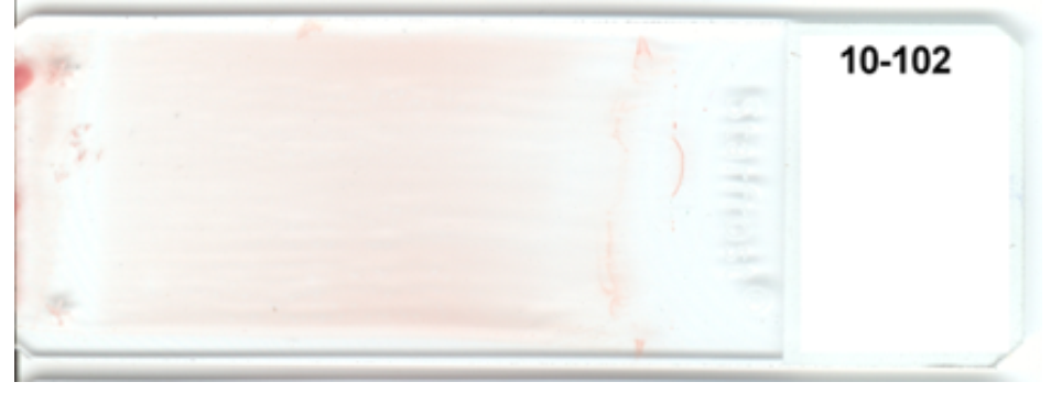 <strong> -The appearance of this blood smear is caused by using(check all that apply) i. too small of a drop of blood ii. too slow of a spreading speed iii. too shallow of an angle of the spreader slide iv. a start and stop motion</strong> A) i and ii B) ii and iv C) i and iii D) ii and iii