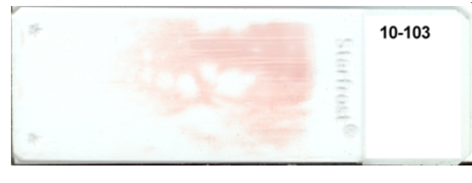 <strong> -The appearance of this blood smear is caused by using (check all that apply)</strong> A) a slide with fingerprints on it B) unequal pressure on the spreader slide C) a chipped slide for the spreader slide D) a start and stop motion