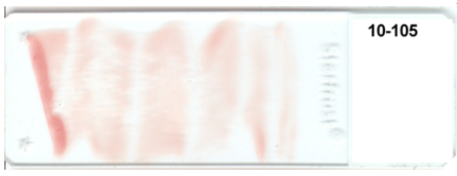 <strong> -The appearance of this blood smear is caused by using (check all that apply)</strong> A) a slide with fingerprints on it B) unequal pressure on the spreader slide C) a chipped slide for the spreader slide D) a start and stop motion