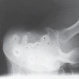 <strong>Which carpal bone is 4? </strong> A) Scaphoid B) Trapezoid C) Hamate D) Lunate